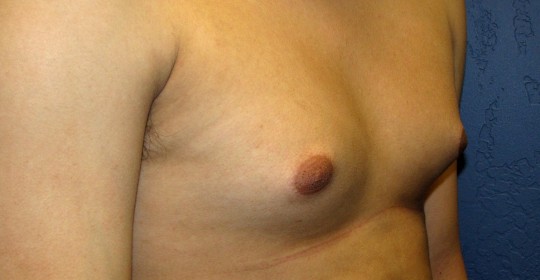 Gynecomastia