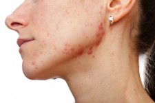 Acne Scars/Injury Scars