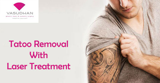 Tattoo Removal with Laser Treatment