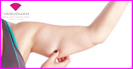 Benefits of Arm Liposuction