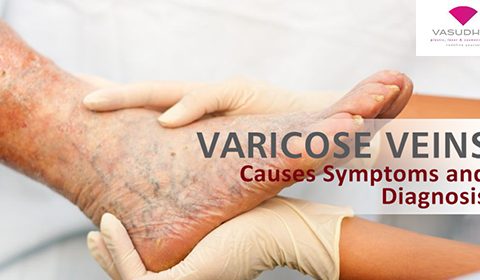 Varicose Veins – Symptoms and Causes