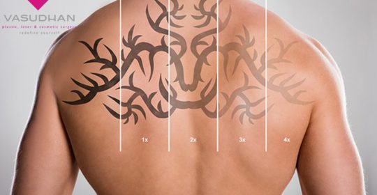 The Benefits and Side Effects of Laser Tattoo Removal