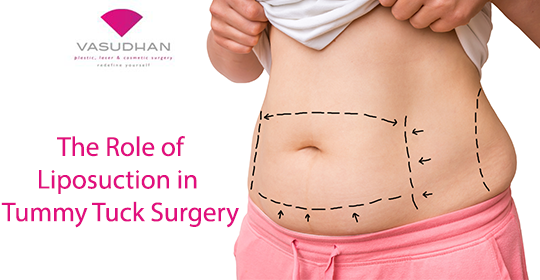 The Role of Liposuction in Tummy Tuck Procedure