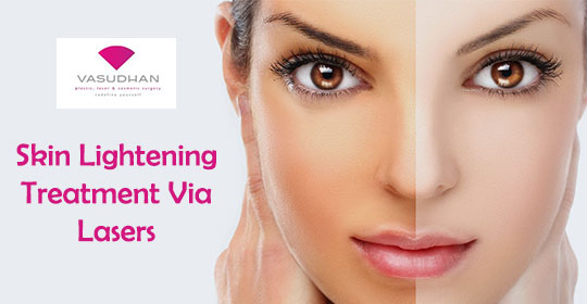 Skin Lightening Treatment via Lasers