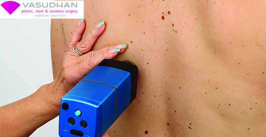 Birthmark Removal With Lasers