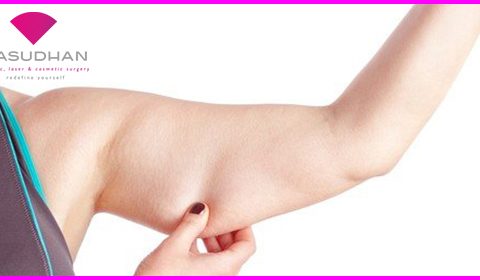 Benefits of Arm Liposuction