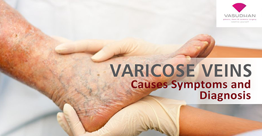Varicose Veins – Symptoms and Causes